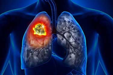 نتایج امیدوارکننده قرص سرطان ریه در آزمایش‌های انسانی